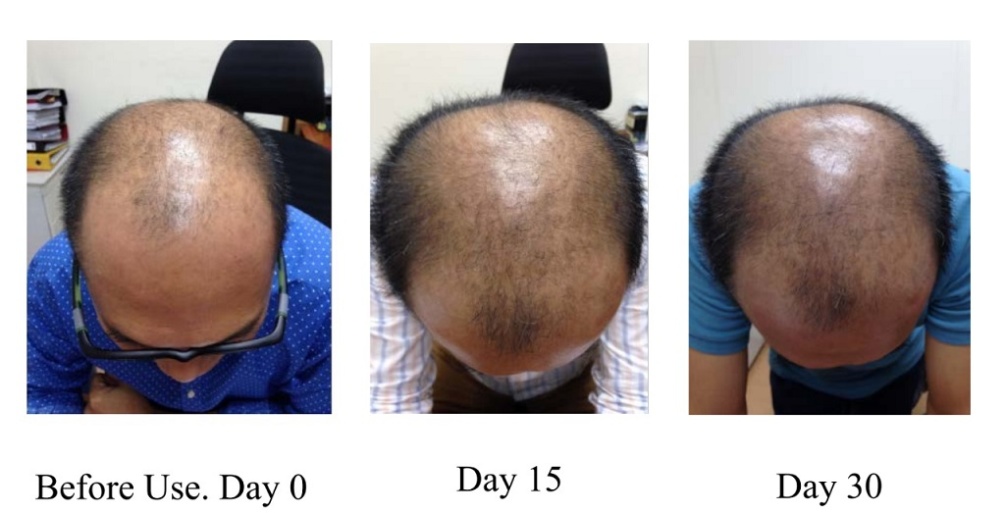 #1 World's Fastest Acting Hair Growth Shampoo.
Stops Fu... XP - UP Hair Growth Shampoo - 300ml photo-3